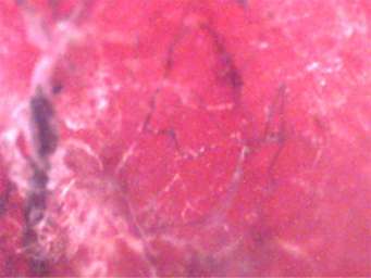 Heel lesions on a 3 year old male showing fibers enlarged 60 times.