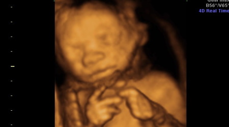 Pro-Abortion Group Says Unborn Babies Are Just Bacteria