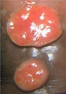 Lymphogranuloma Venereum or LGV painful lesion infection